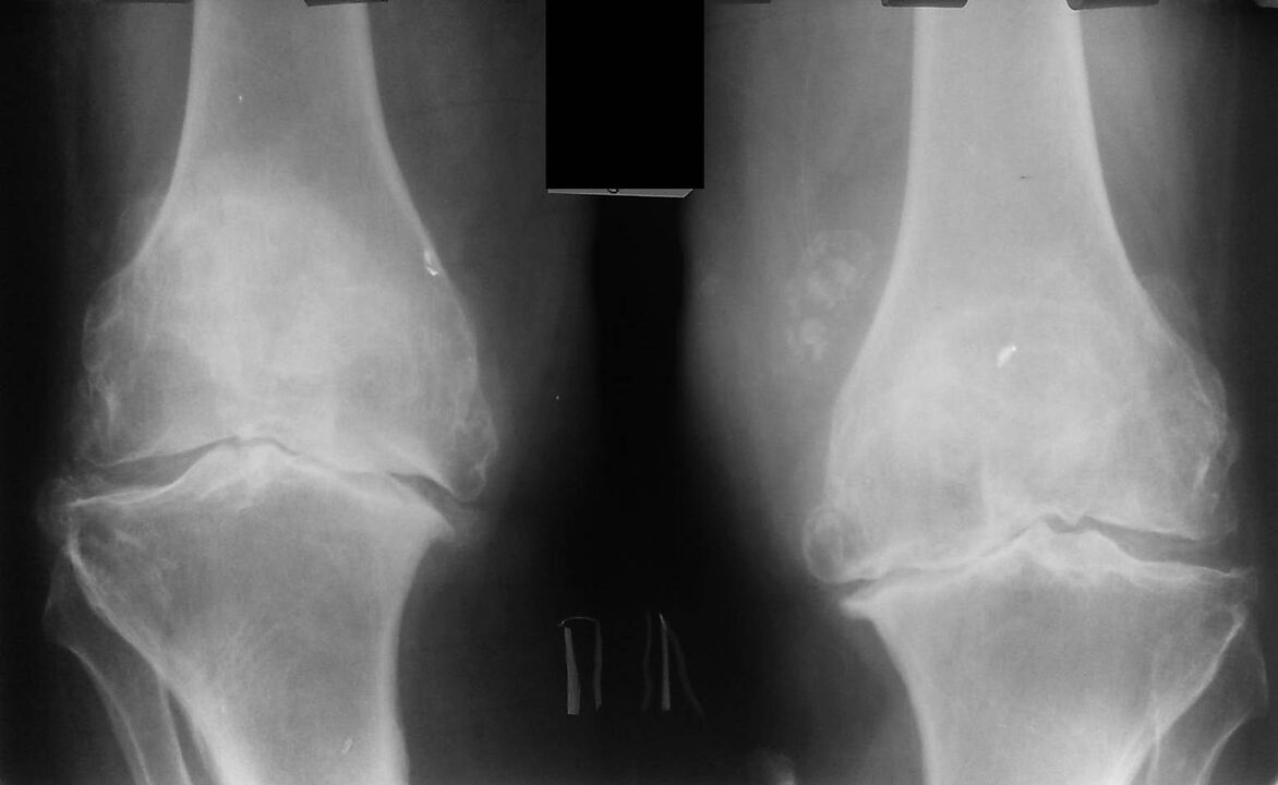 röntgen der kniegelenke mit arthrose
