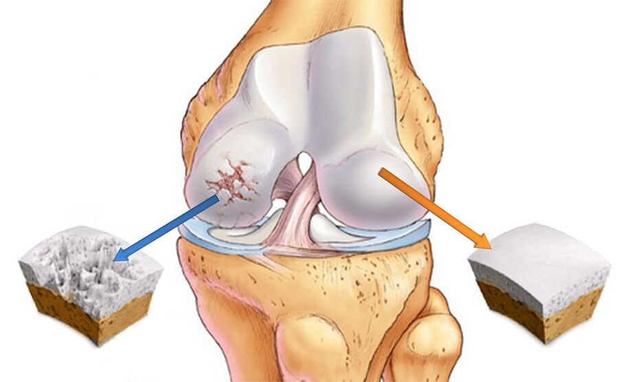 Kniegelenks -Osteoarthritis