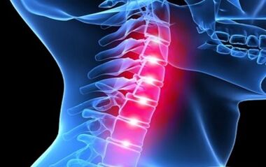 Symptome einer Osteochondrose der Halsspalte