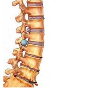 Wie sich die Osteochondrose der Gebärmutterhalsregion entwickelt