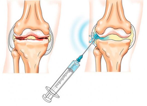 intraartikuläre Injektionen bei Osteoarthritis des Knies