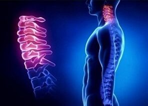 Die Gründe für die Entwicklung der Gebärmutterhalsosteochondrose