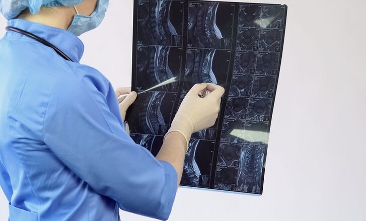 Die Diagnose einer zervikalen Osteochondrose wird auf der Grundlage einer MRT-Untersuchung gestellt. 