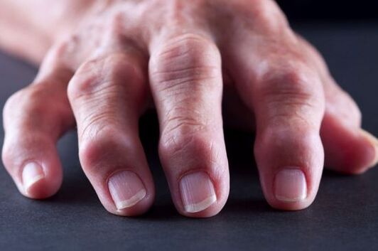 Gelenkdeformationen der Finger aufgrund von Arthrose oder Arthritis. 